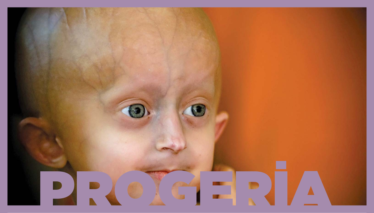 Erken Yaşlanma Sendromu: Progeria
